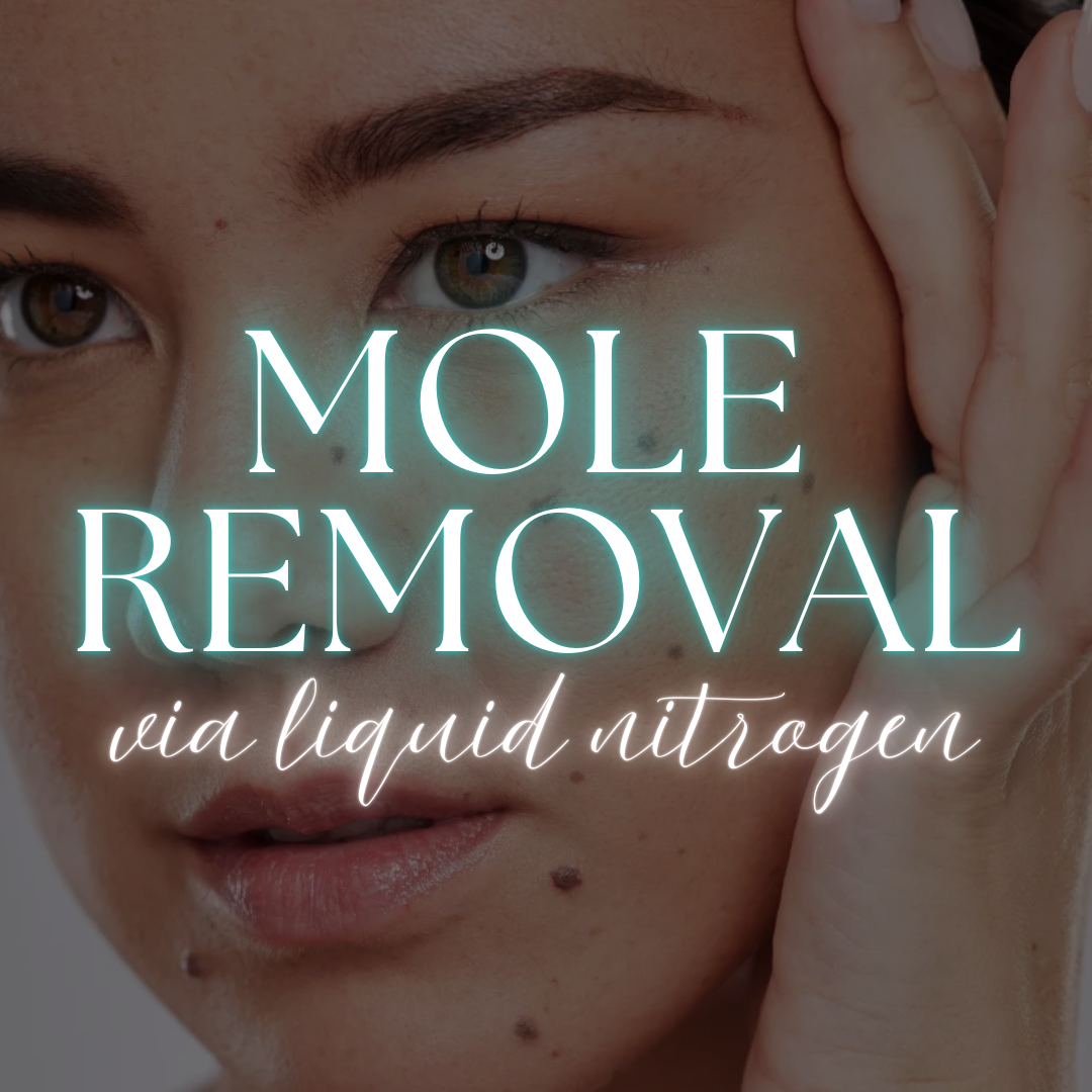 Mole Removal with Liquid Nitrogen