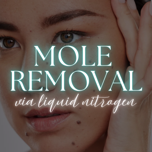 Mole Removal with Liquid Nitrogen
